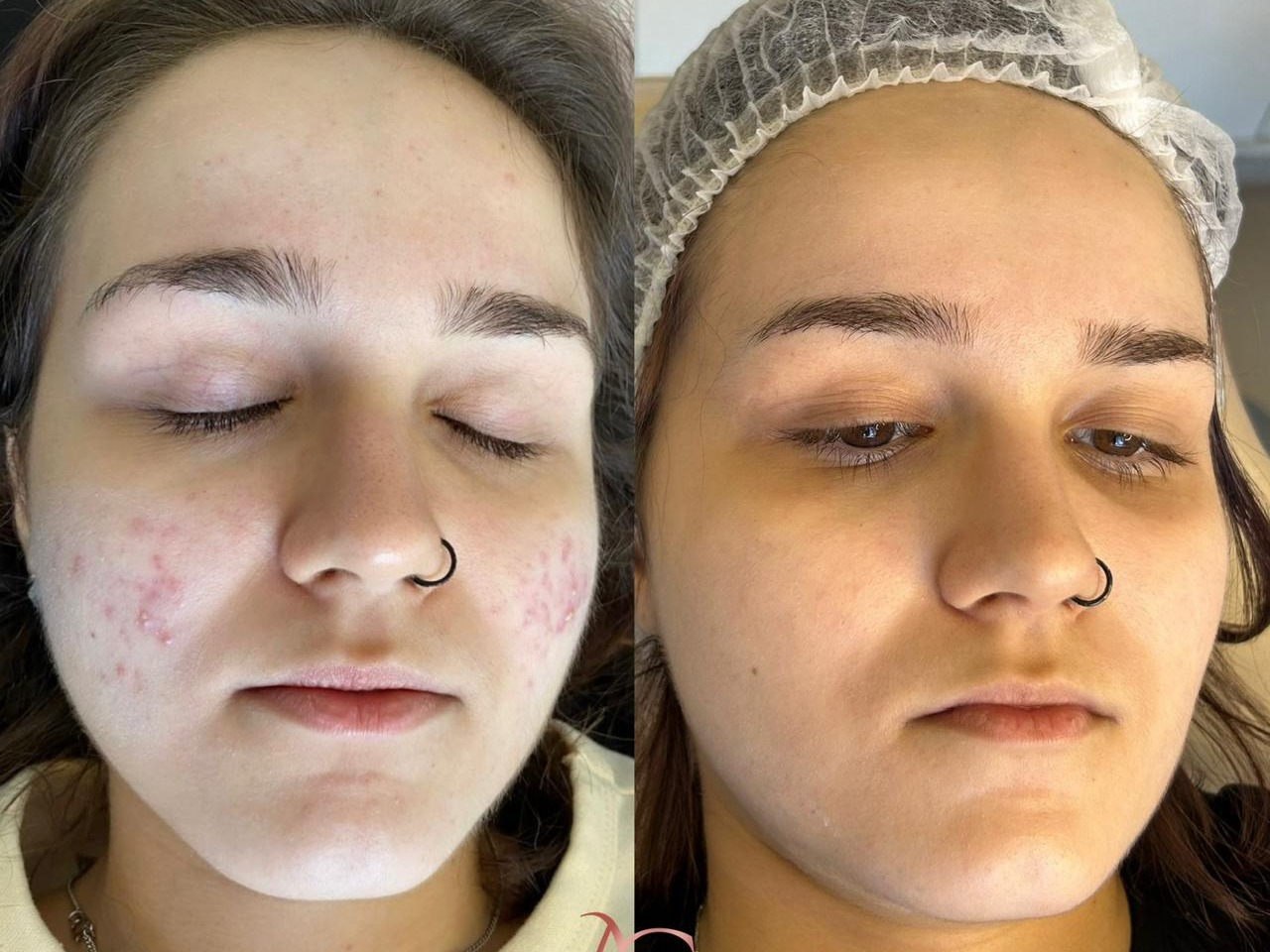 Resultado de Limpeza de Pele